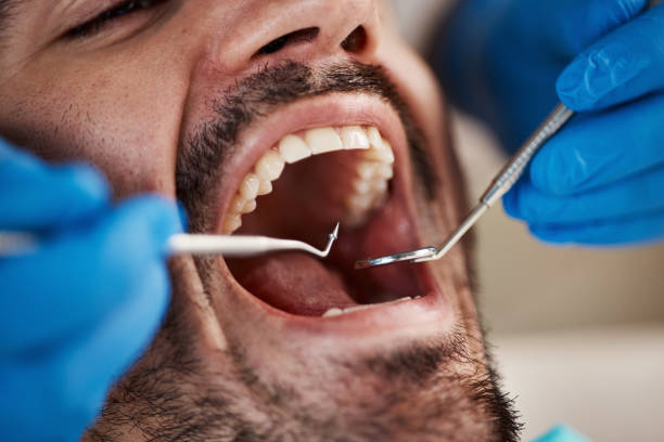 Best Emergency Tooth Extraction in Dellwood, MN